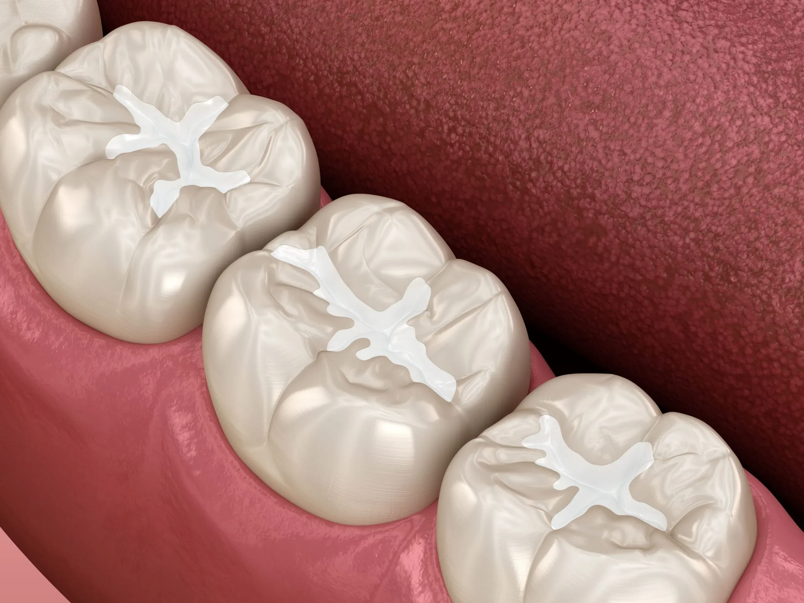 comprehensive guide to composite fillings a complete overview