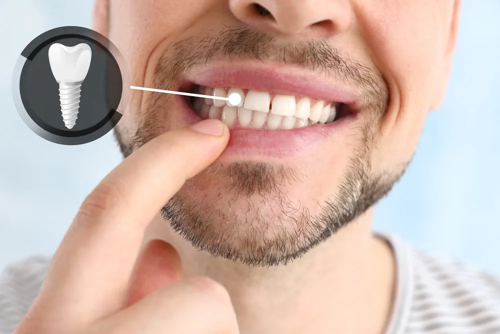 things you didn’t know about dental implants