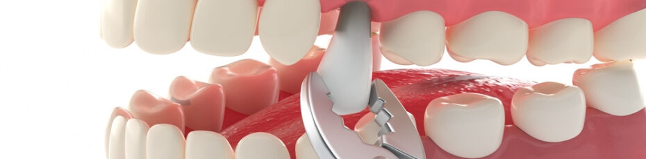 ways to replace an extracted tooth