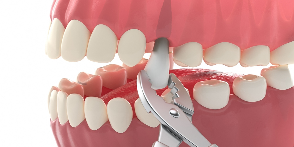 ways to replace an extracted tooth