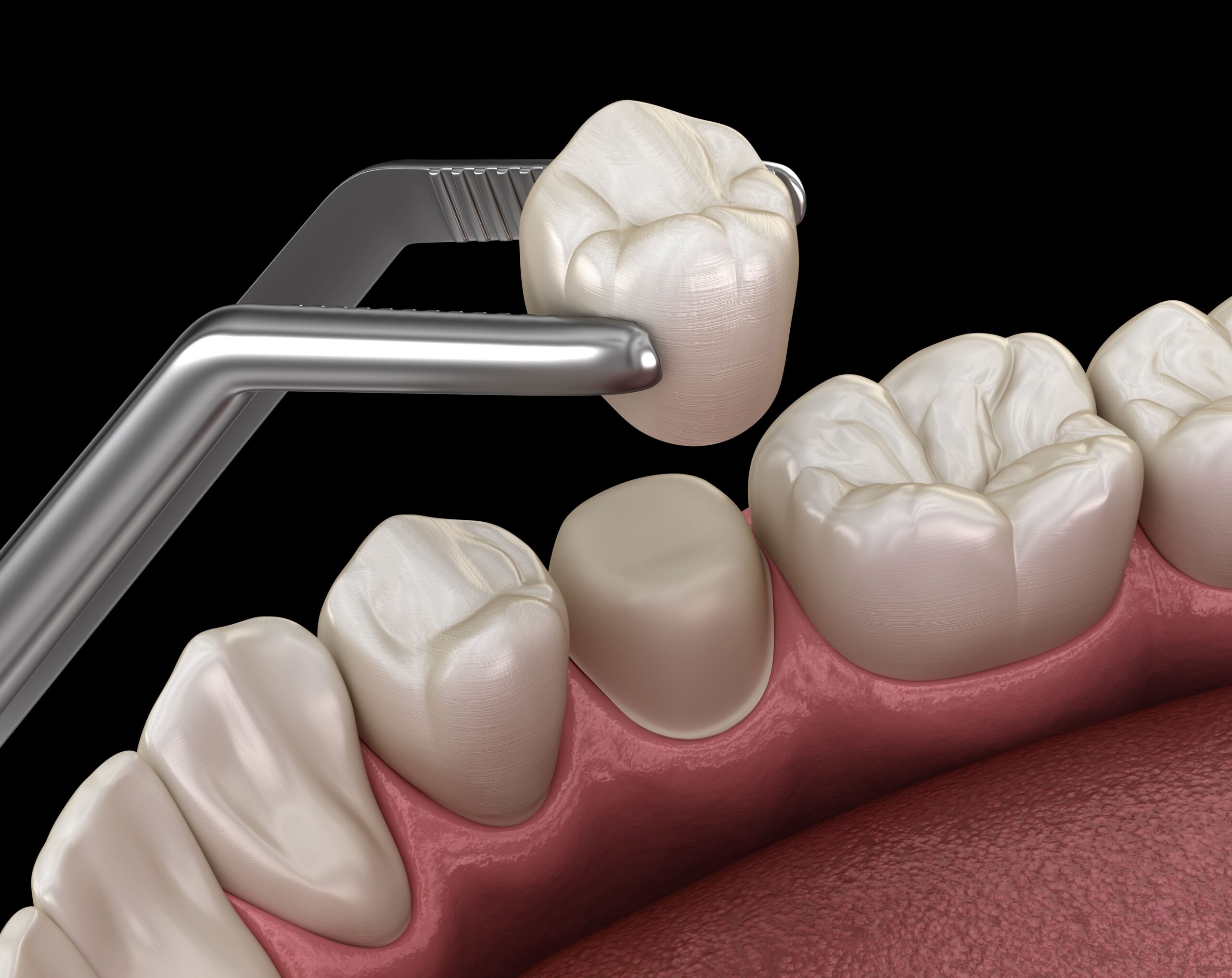 the complete guide to dental crowns