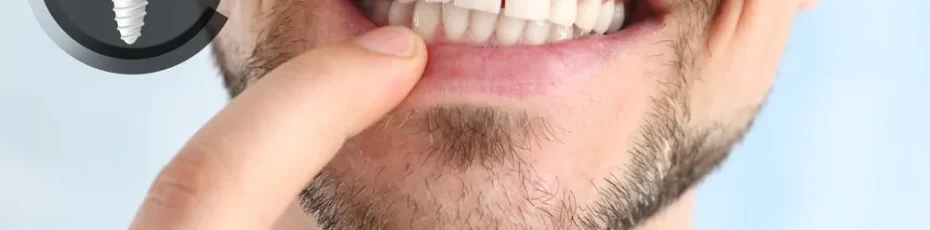 things you didn’t know about dental implants