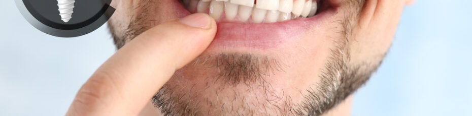 15 things you didn’t know about dental implants