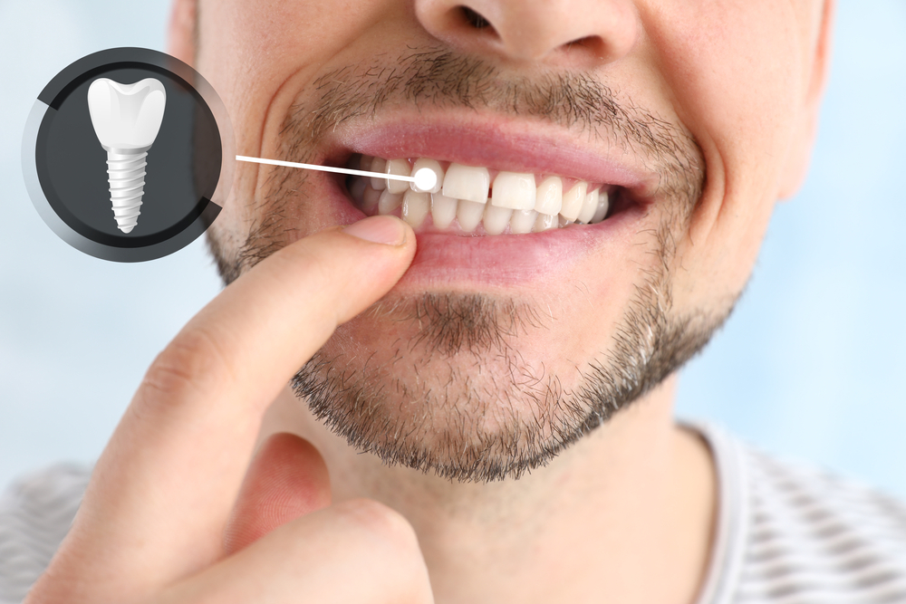 15 things you didn’t know about dental implants