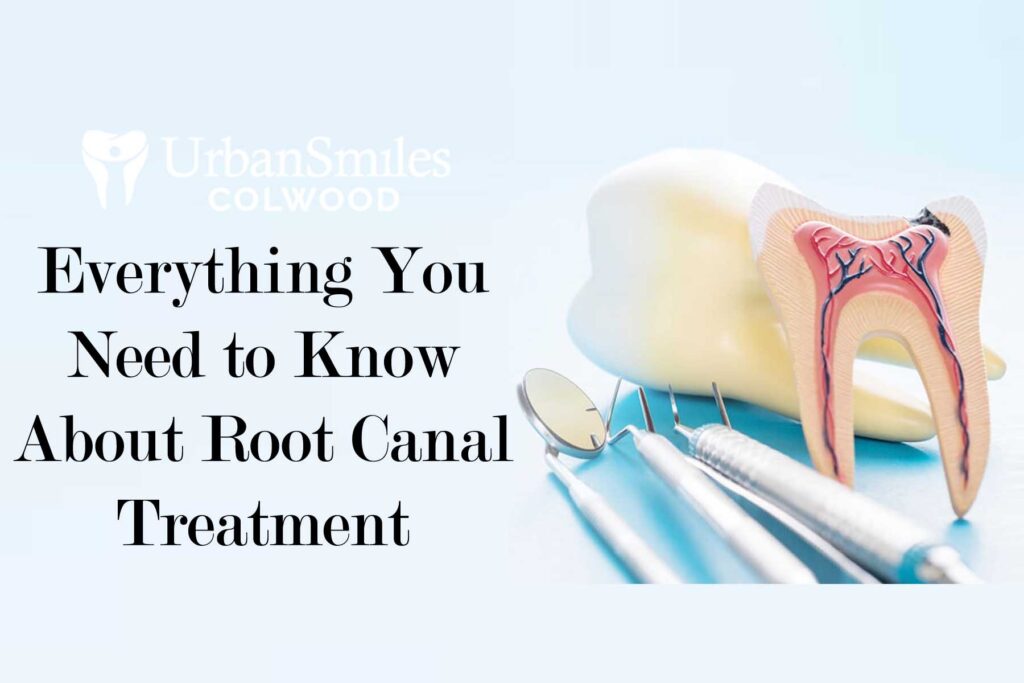 Root Col Everything You Need to Know About Root Canal Treatment - Urban Smiles ...