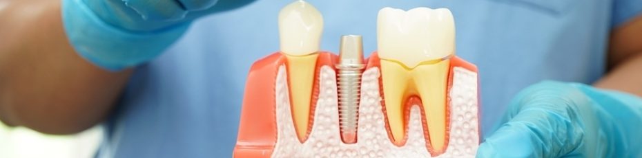 Preventing Bone Loss : The Benefits of Dental Implants
