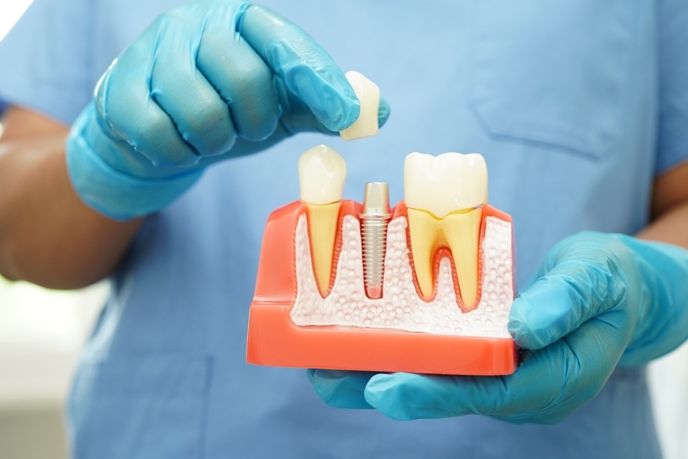 Preventing Bone Loss : The Benefits of Dental Implants