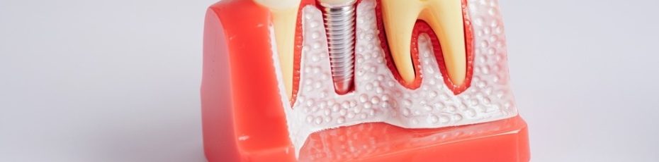 The Ultimate Patient Guide to Dental Implants