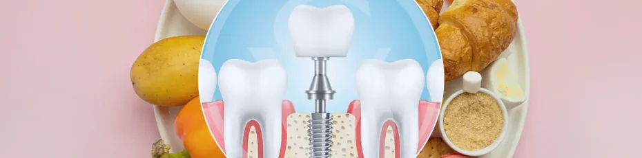 From Surgery to Recovery: Dietary Timeline After Dental Implants